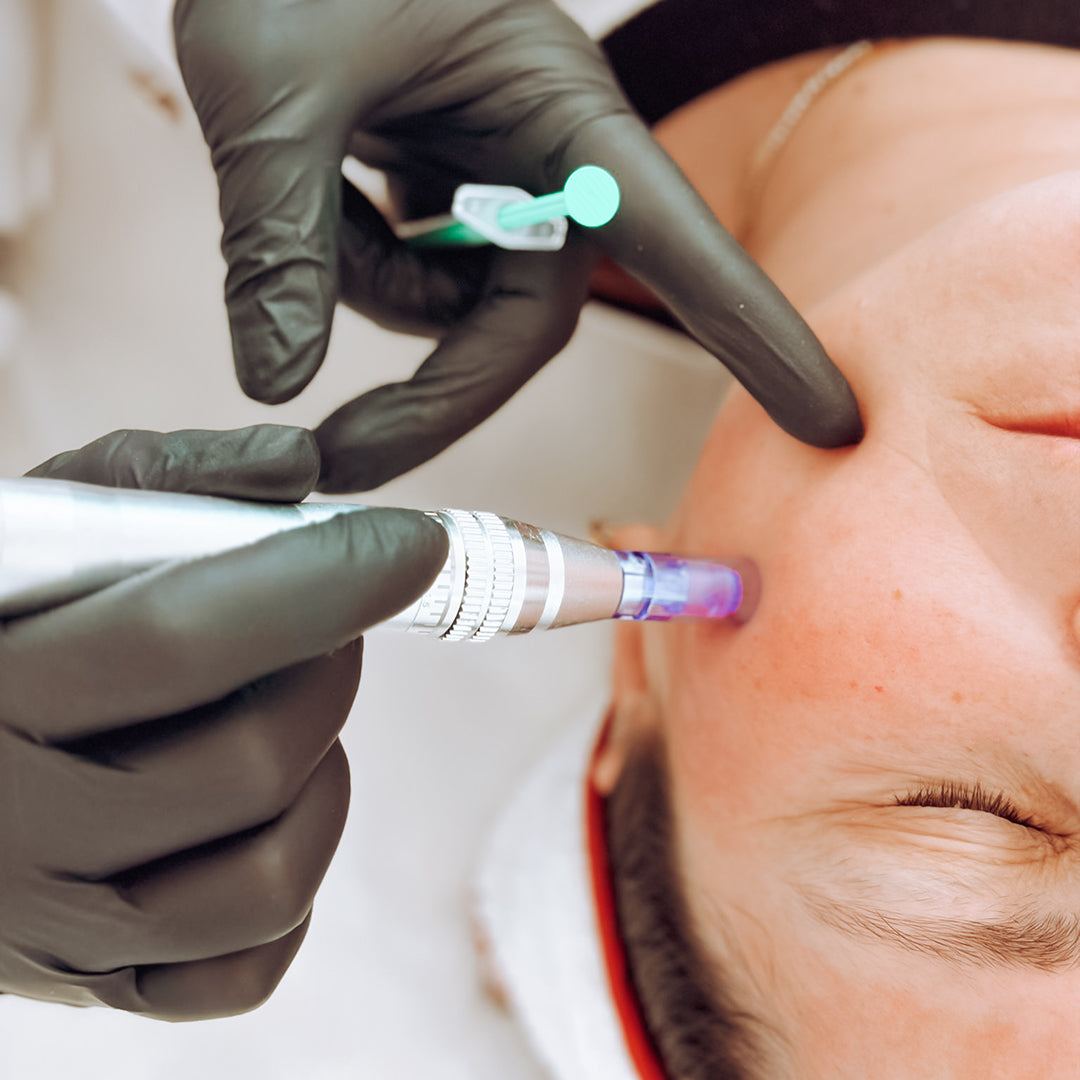 Microneedling